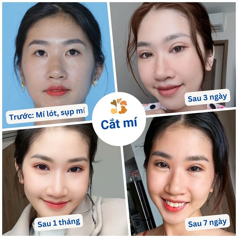 Mí mắt phục hồi nhanh chỉ sau vài ngày, không gây ảnh hưởng đến thị lực