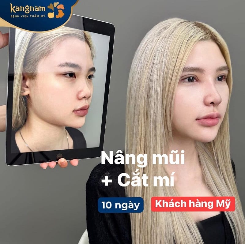 Bạn gái Việt kiều Mỹ thực hiện combo cắt mí và nâng mũi