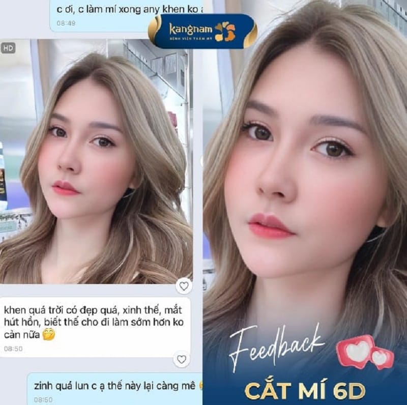 Feedback chất lượng của khách hàng Việt Kiều Úc sau 2 tháng cắt mí 6D