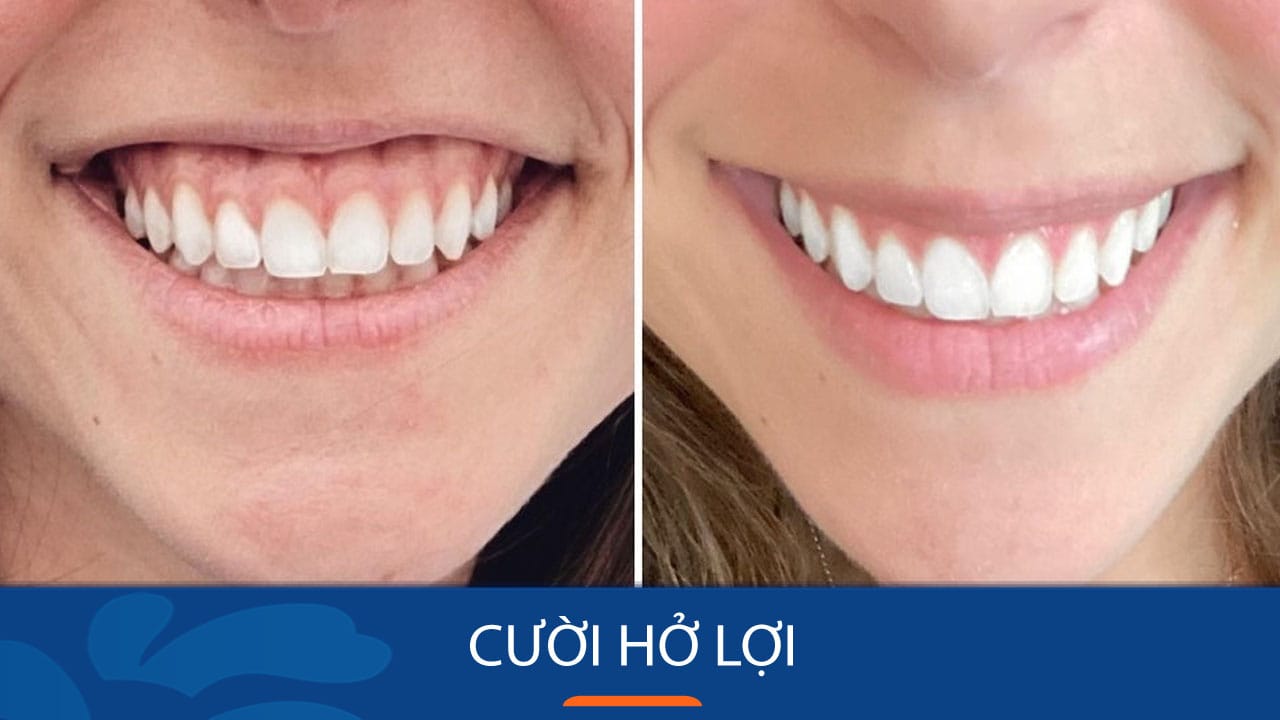 Khách hàng Việt Kiều đến BV Kangnam làm Phẩu thuật chữa Cười hở lợi