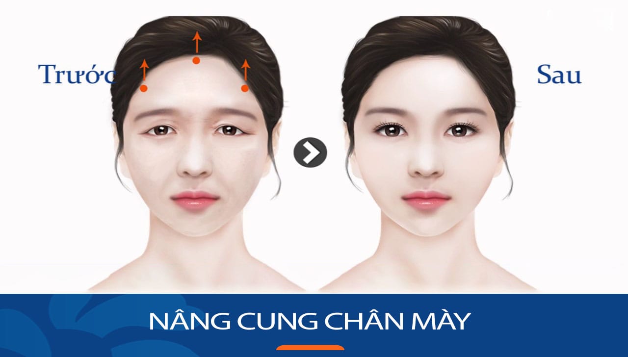 Khách hàng Việt Kiều Nâng cung chân mày tại BV Kangnam