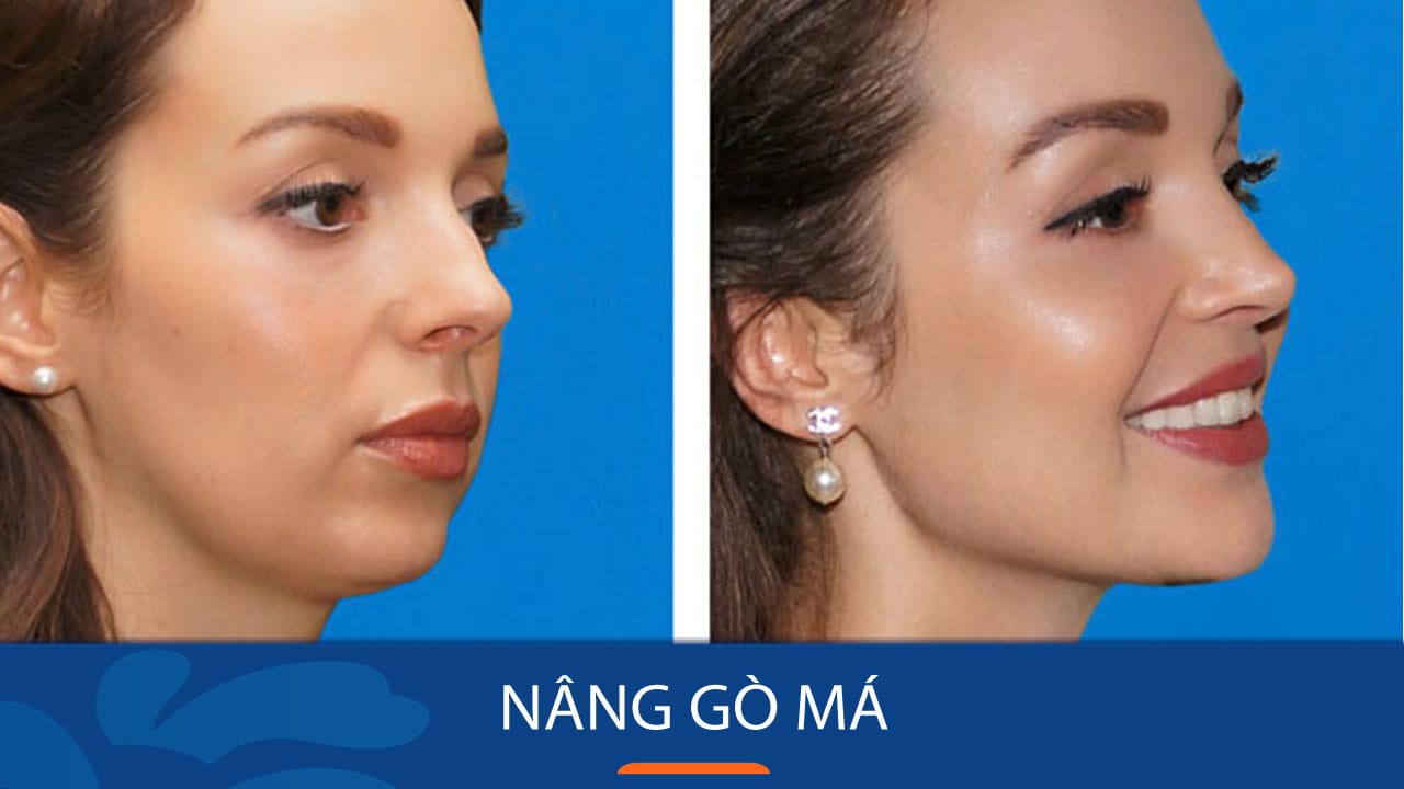 Nâng gò má thấp cho Việt Kiều- Tái sinh nhan sắc với đôi gò má căng tròn