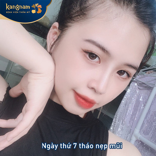 Nâng mũi tự thân tại Kangnam hồi phục nhanh