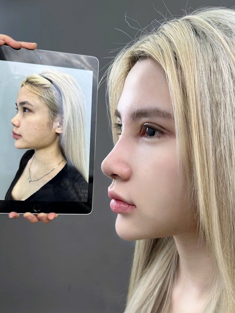 Dáng mũi đẹp tự nhiên sau nâng mũi cấu trúc