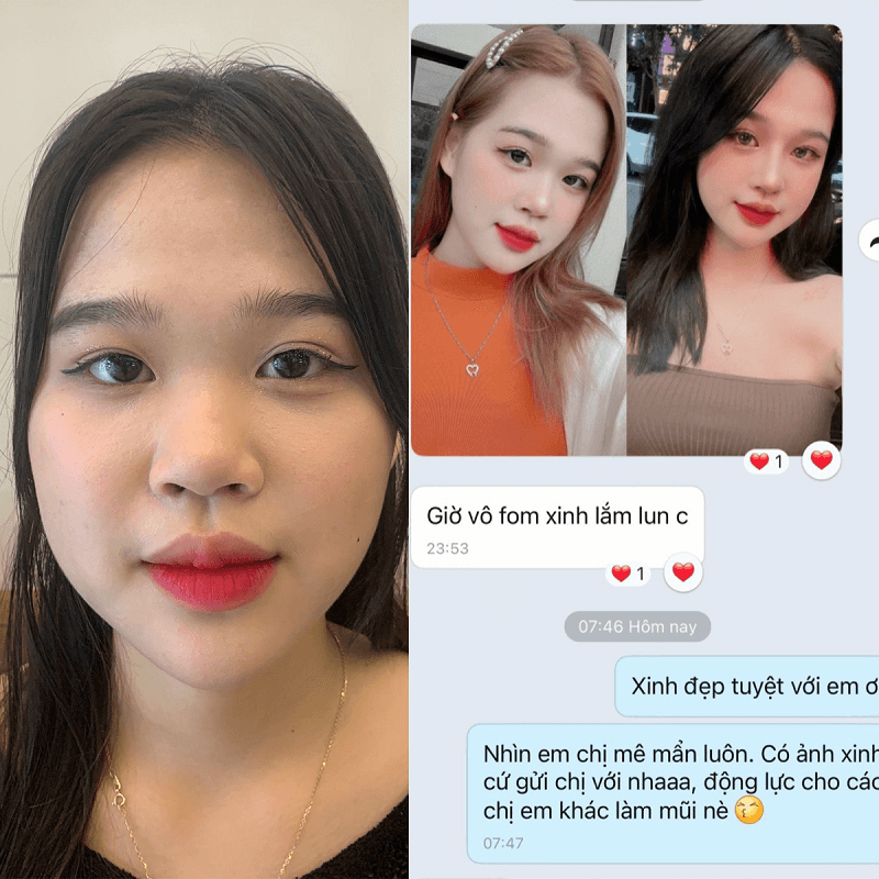 Khách hàng thăng hạng nhan sắc sau nâng mũi