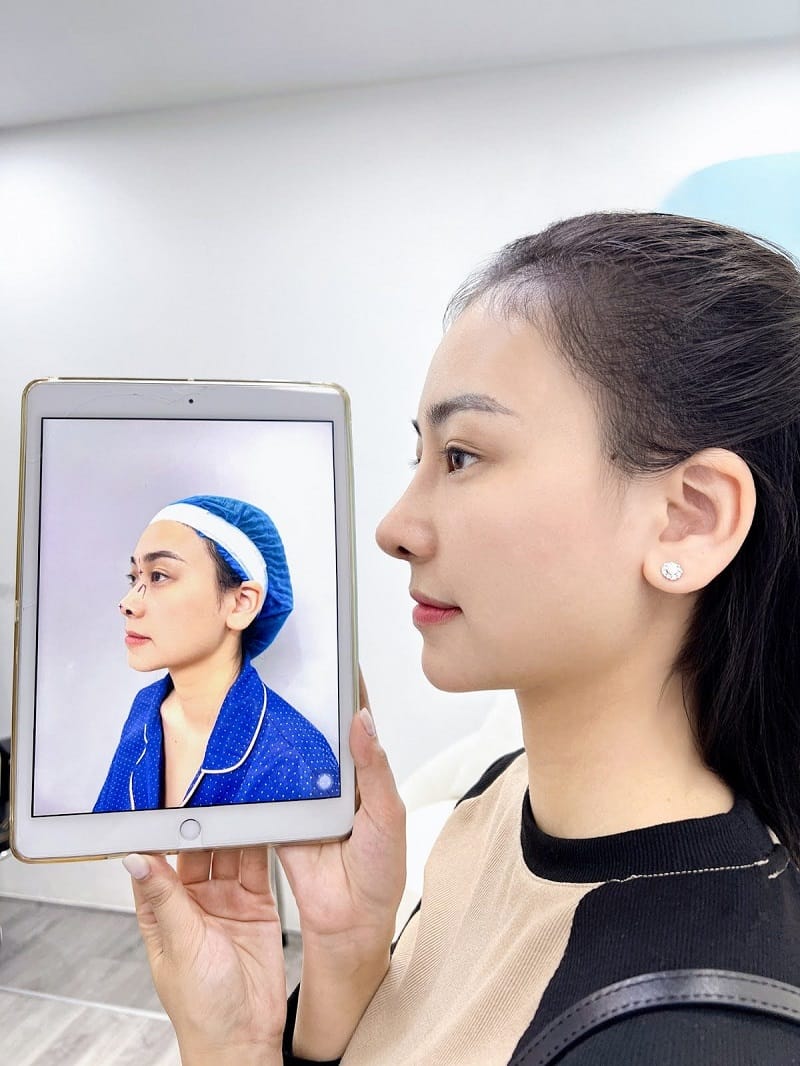 Hình ảnh thực tế khách hàng trước và sau nâng mũi