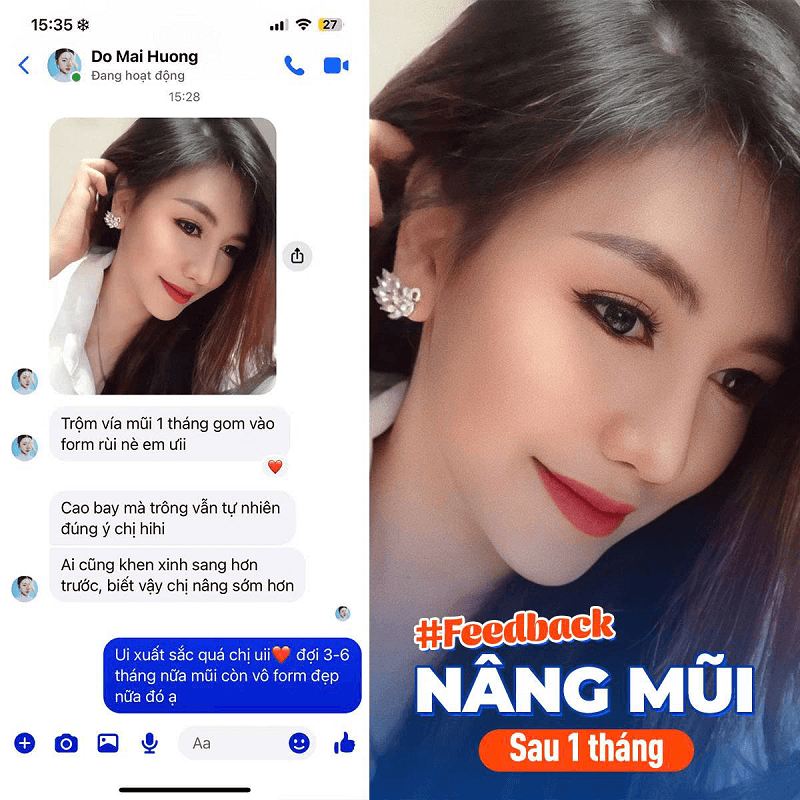 Dáng mũi sau 1 tháng thực hiện, vào form đẹp tự nhiên