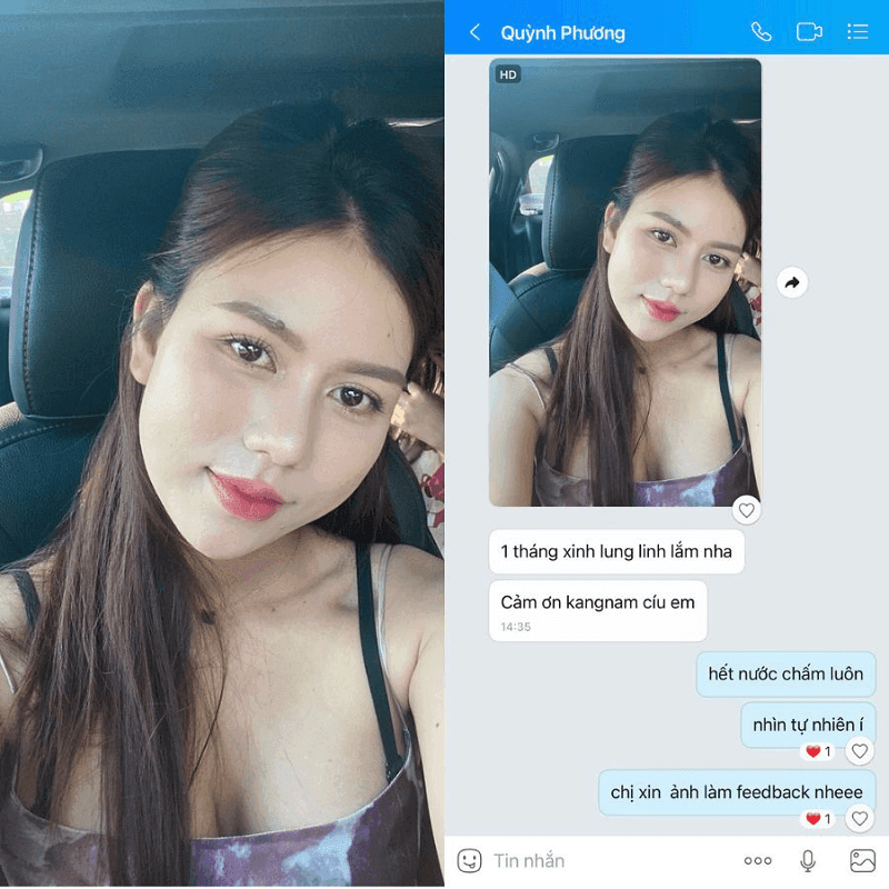 Chị khách rất ưng ý với dáng mũi mới