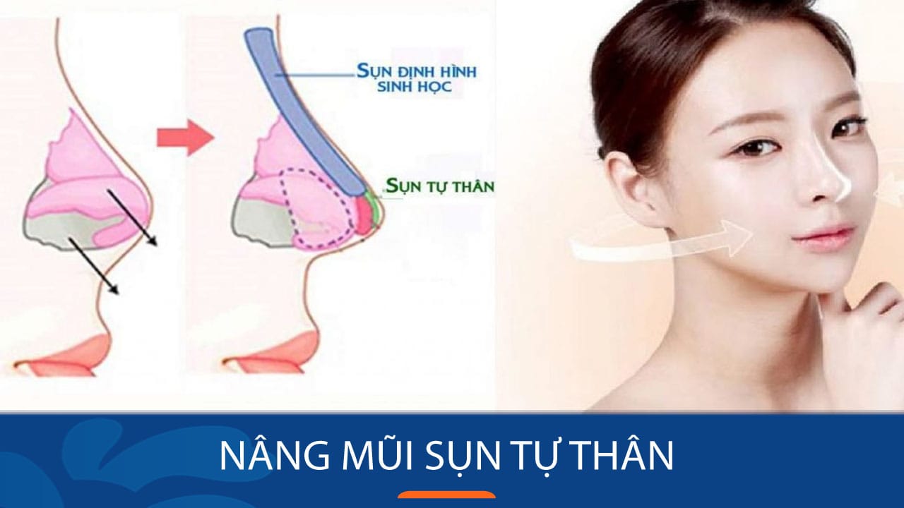 Nâng mũi sụn tự thân: Kiến thức nâng cao cho KH việt kiều