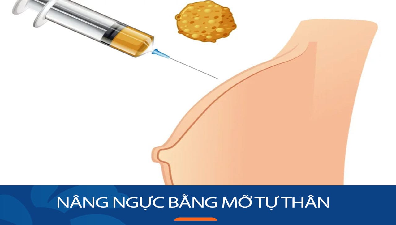 Nâng ngực bằng mỡ tự thân giải pháp hồi phục nhanh cho Việt Kiều