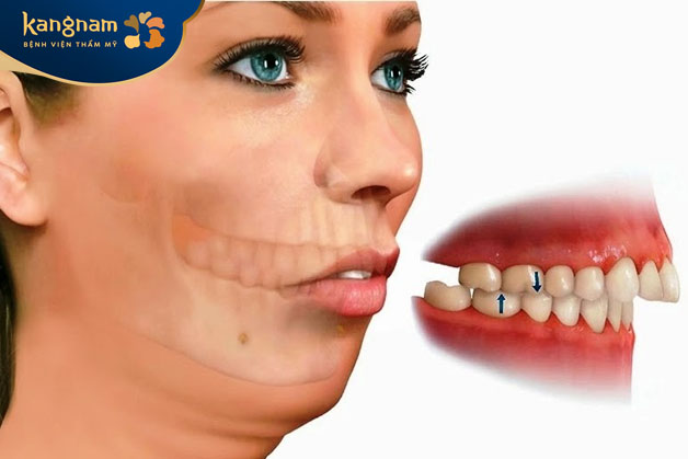 Hàm hô là tình trạng hai hàm răng không khớp với nhau do sự sai lệch của xương hàm trên