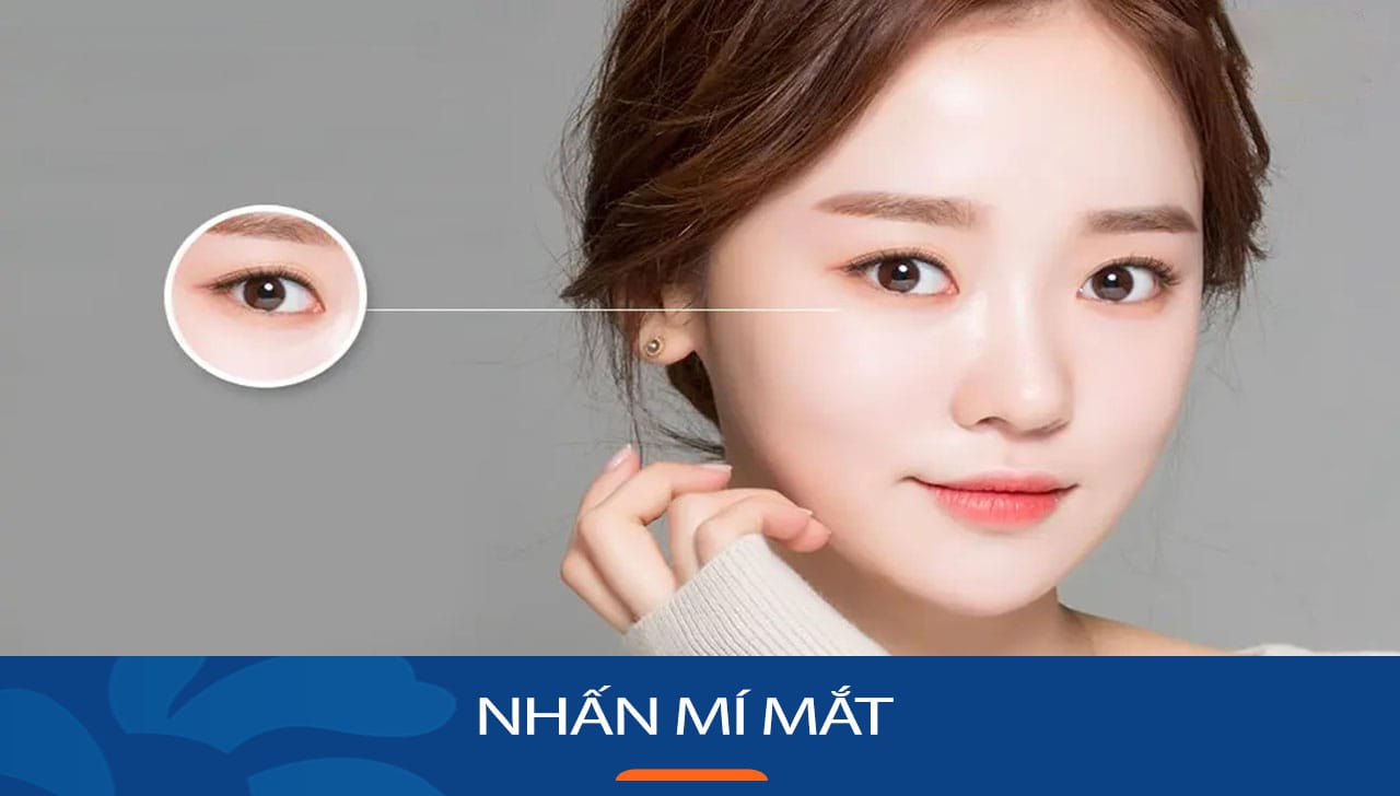 Khách hàng Việt Kiều lựa chọn Nhấn mí mắt tại BV kangnam