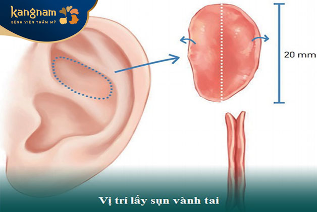 Sụn vành tai là loại sụn tự thân phổ biến