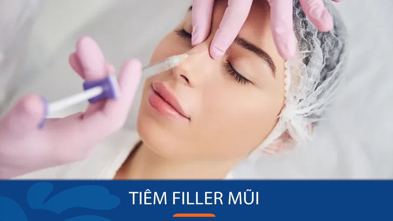 Tiêm filler mũi cho KH việt kiều – Thay đổi diện mạo tự nhiên