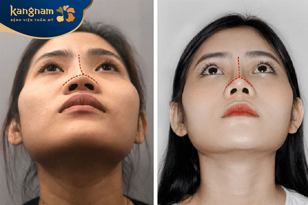 Cắt cánh mũi là phương pháp phẫu thuật thẩm mỹ giúp điều chỉnh hình dáng mũi