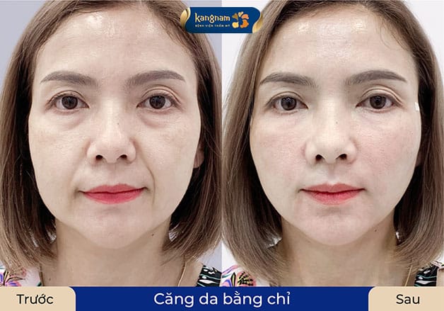 Kết quả thấy rõ sau khi căng chỉ