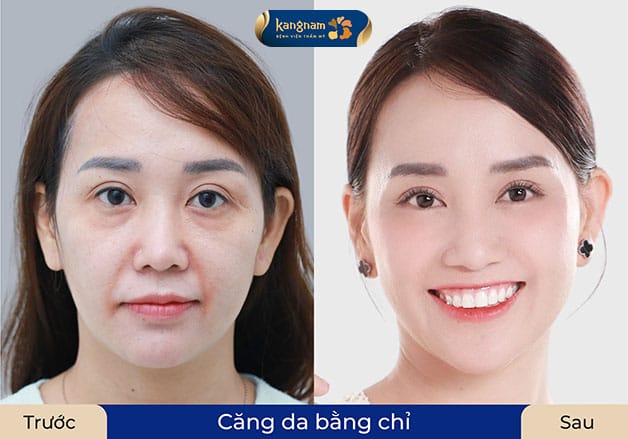 Trẻ hóa da sau căng chỉ