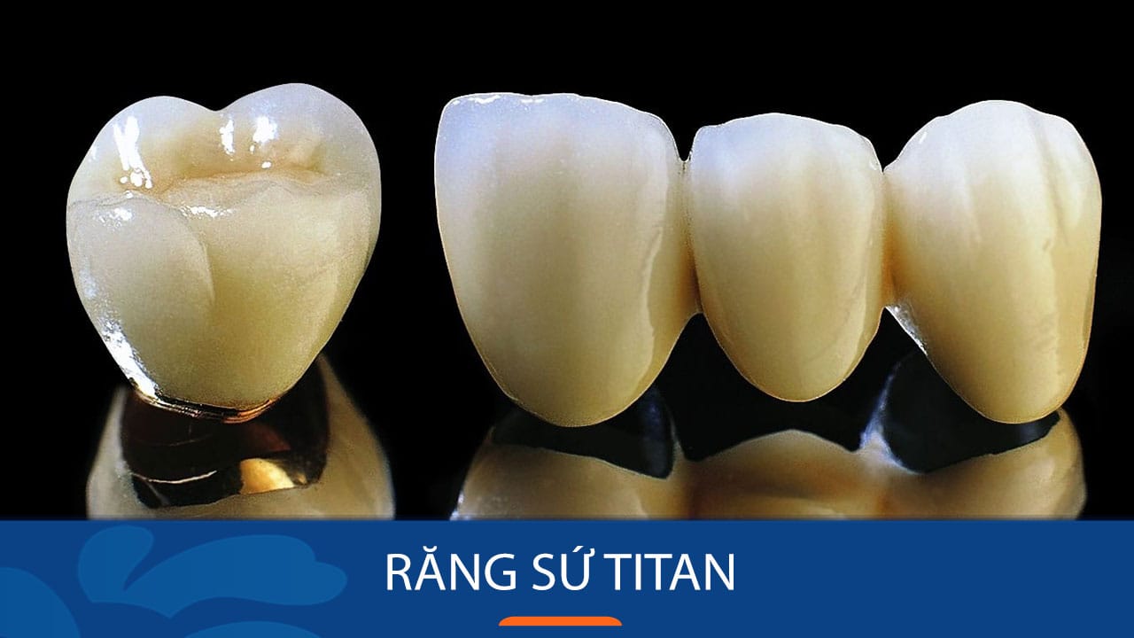 Địa chỉ bọc Răng sứ Titan uy tín cho khách hàng Việt Kiều