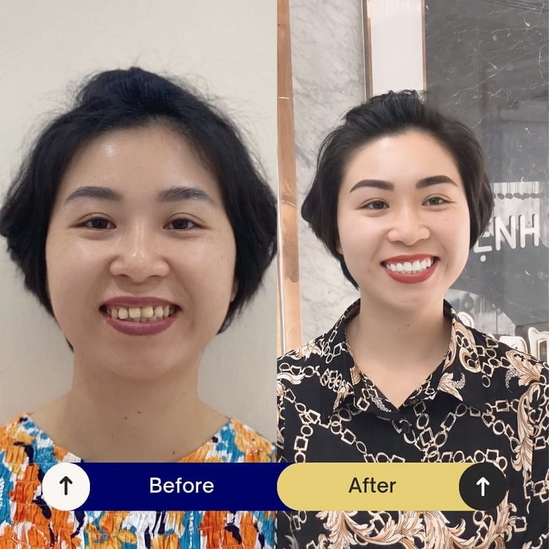 Khách hàng sở hữu nụ cười tươi, rạng rỡ sau bọc răng sứ