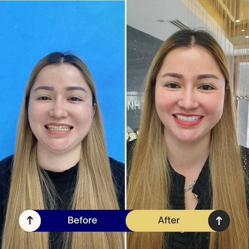 Thiết kế hàm răng bằng công nghệ hiện đại, giúp khách hàng sở hữu nụ cười tươi, rạng rỡ