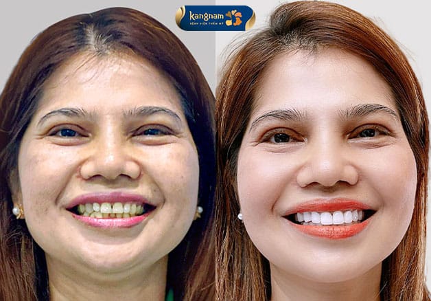 Bọc răng sứ duy trì được kết quả lâu dài