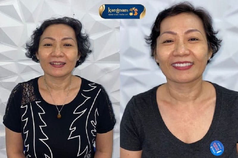 Thời gian thực hiện tại Kangnam diễn ra nhanh