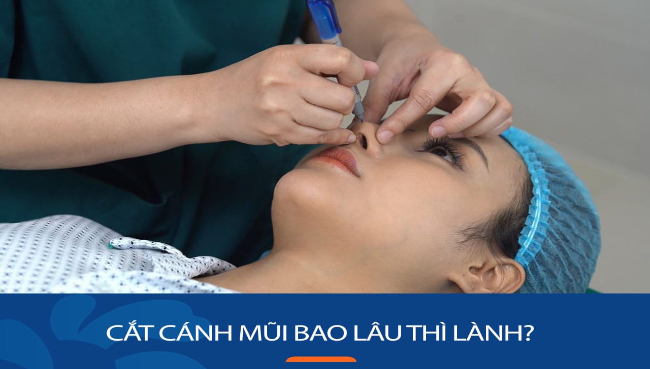 Cắt cánh mũi bao lâu thì lành? Kinh nghiệm dành cho KH Việt Kiều