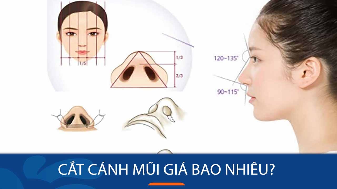 Cắt cánh mũi giá bao nhiêu? Chi phí ưu đãi cho KH Việt Kiều