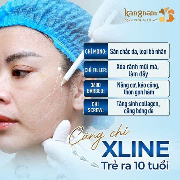 Căng chỉ Xline có nhiều ưu điểm vượt trội
