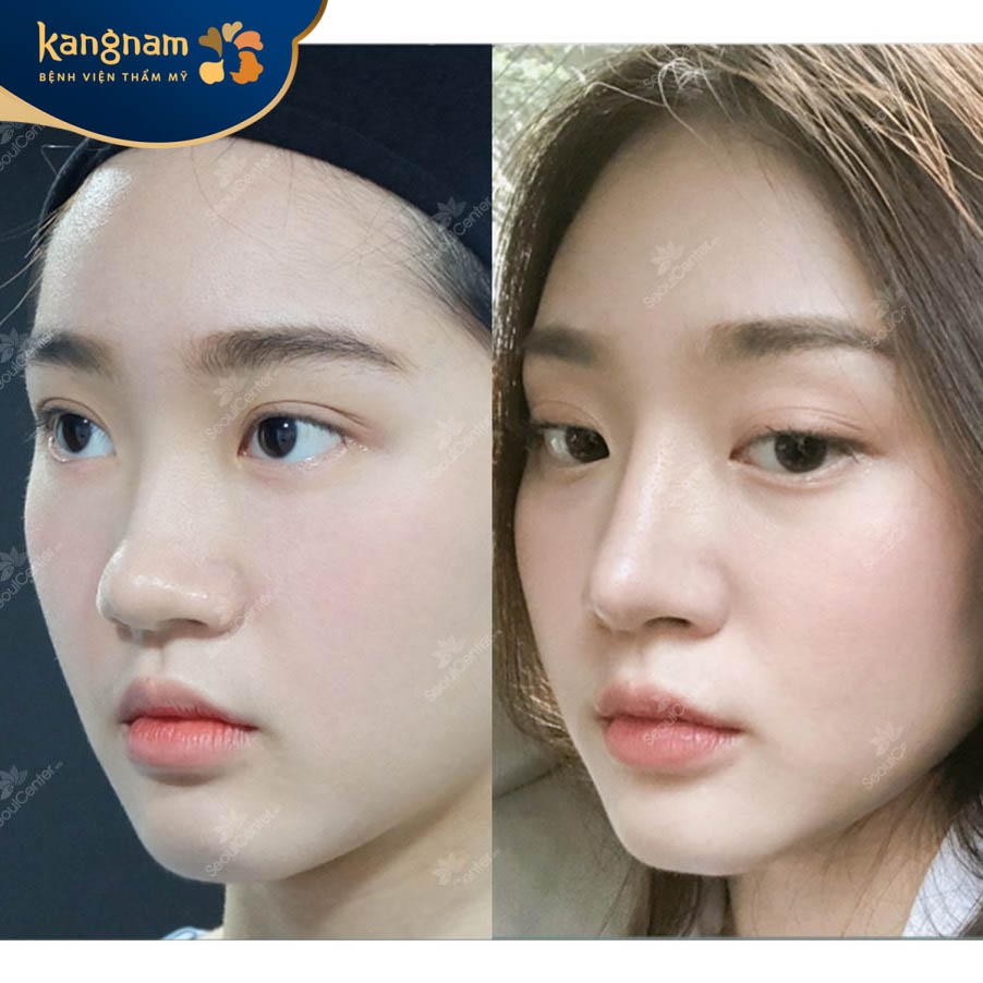 Cánh mũi thon gọn sau khi thẩm mỹ mũi tại Bệnh viện thẩm mỹ Kangnam