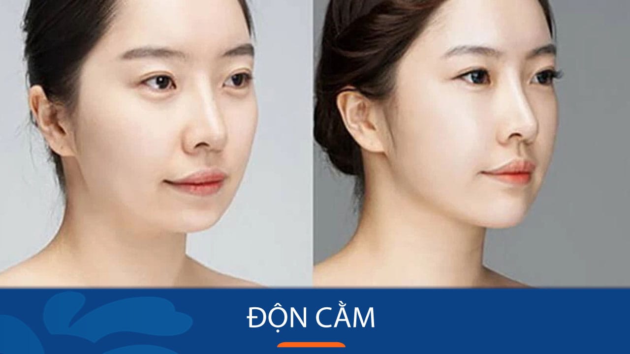 Độn cằm V-line thời thượng dành riêng cho Việt Kiều – Xu hướng làm đẹp