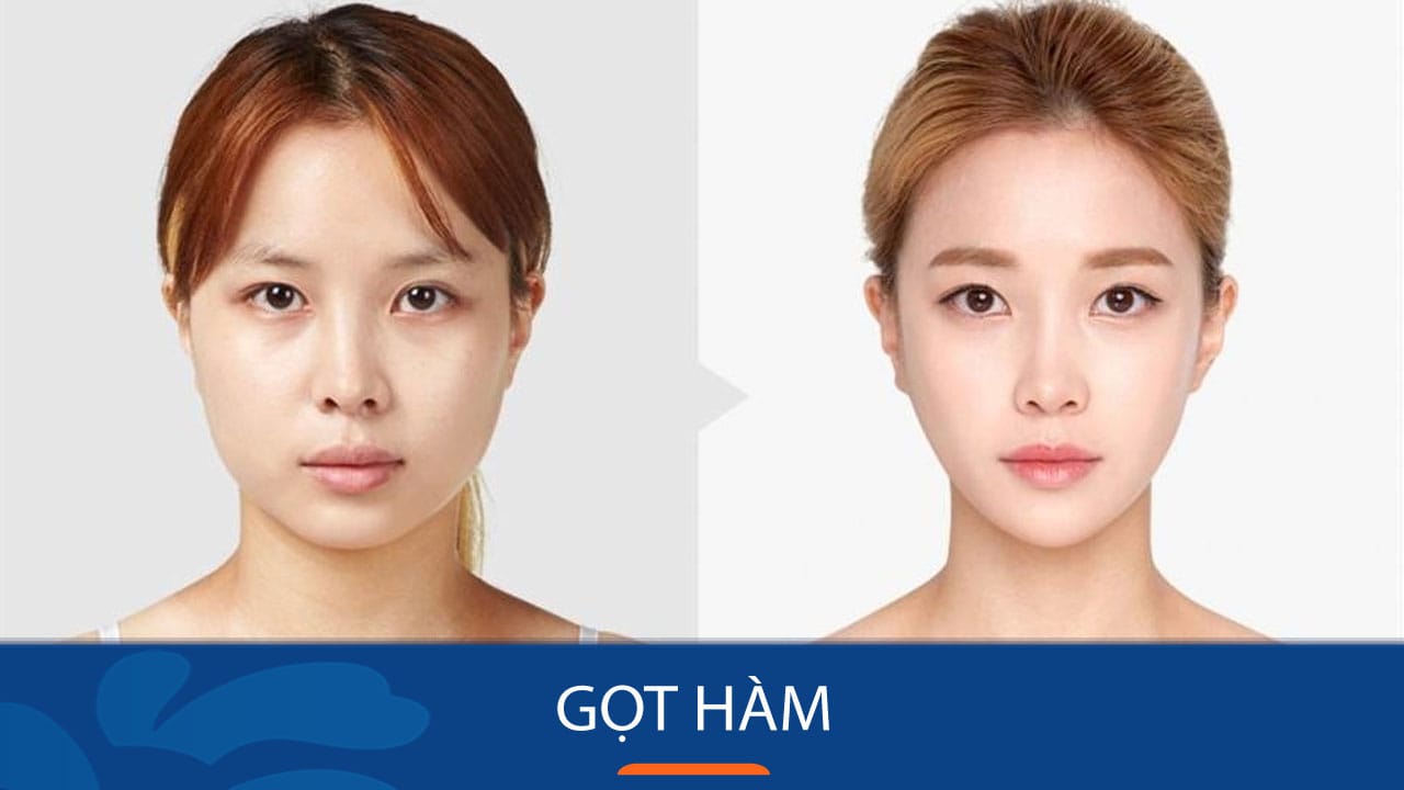 Gọt hàm – Giải pháp hoàn hảo cho khuôn mặt thon gọn và hài hòa khách hàng Việt Kiều