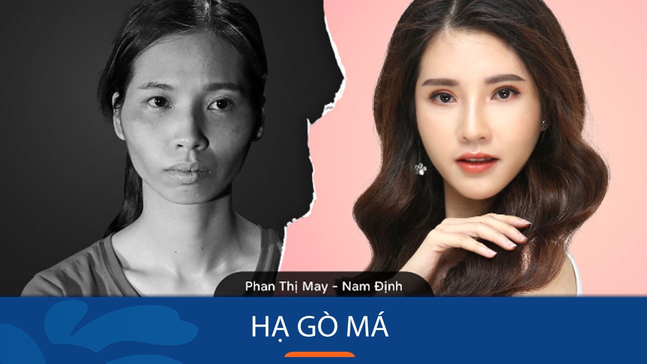 Hạ gò má – Xóa bỏ nỗi lo gò má cao cho khách hàng Việt Kiều