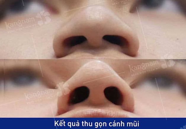 Hiệu quả sau khi phẫu thuật duy trì vĩnh viễn