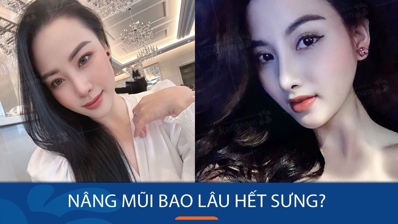 Nâng mũi bao lâu hết sưng? Bí quyết giảm sưng cho KH Việt Kiều