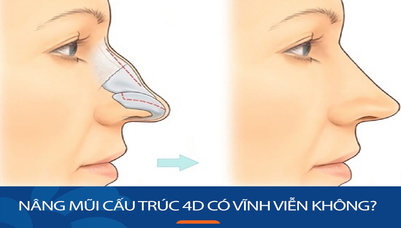 Nâng mũi cấu trúc 4D có vĩnh viễn không? KH Việt Kiều cần biết