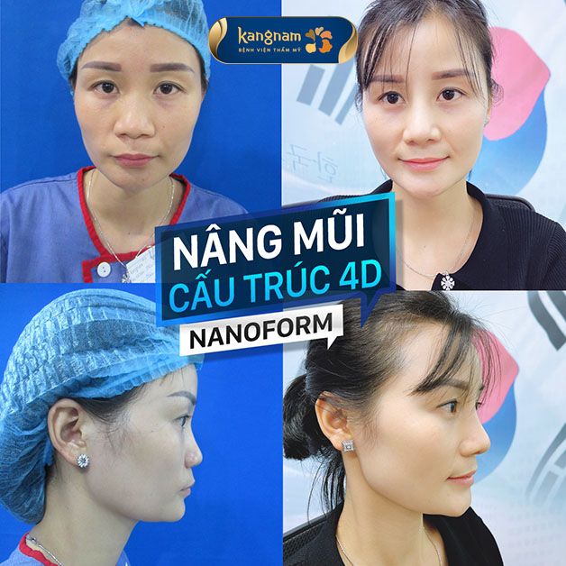 Nữ khách hàng sau khi chỉnh hình nâng mũi tại Kangnam đã cải thiện rất nhiều về nhan sắc