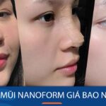 Nâng mũi Nanoform giá bao nhiêu? Chi phí ưu đãi cho KH Việt Kiều
