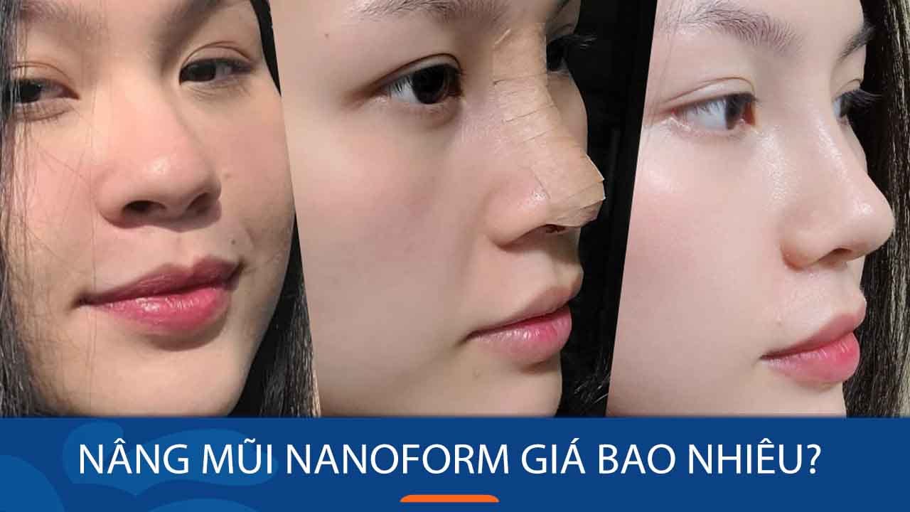 Nâng mũi Nanoform giá bao nhiêu? Chi phí ưu đãi cho KH Việt Kiều