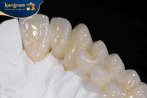 Loại răng sứ Emax CAD được chế tạo bằng công nghệ CAD/CAM