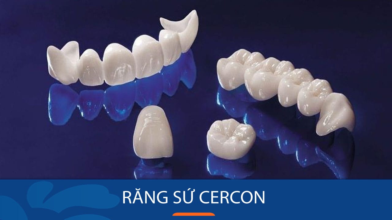 Địa chỉ bọc Răng sứ Cercon Cho Việt Kiều Cực Nhiều Ưu Đãi
