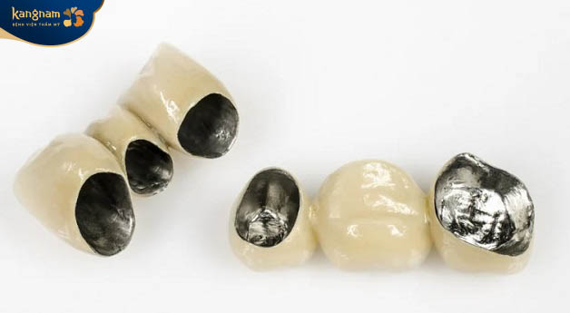 Lớp kim loại bên trong răng sứ