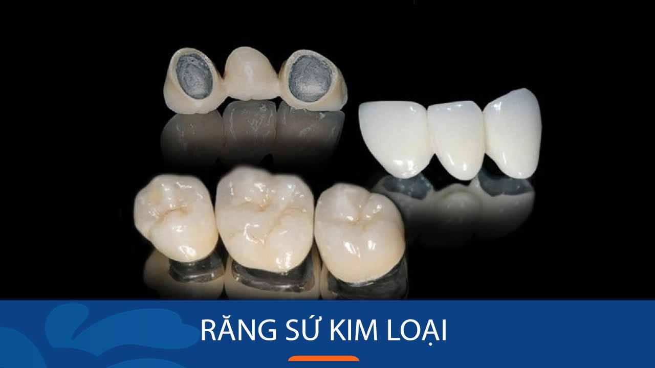 Địa chỉ làm Răng sứ kim loại cho Việt Kiều về nước