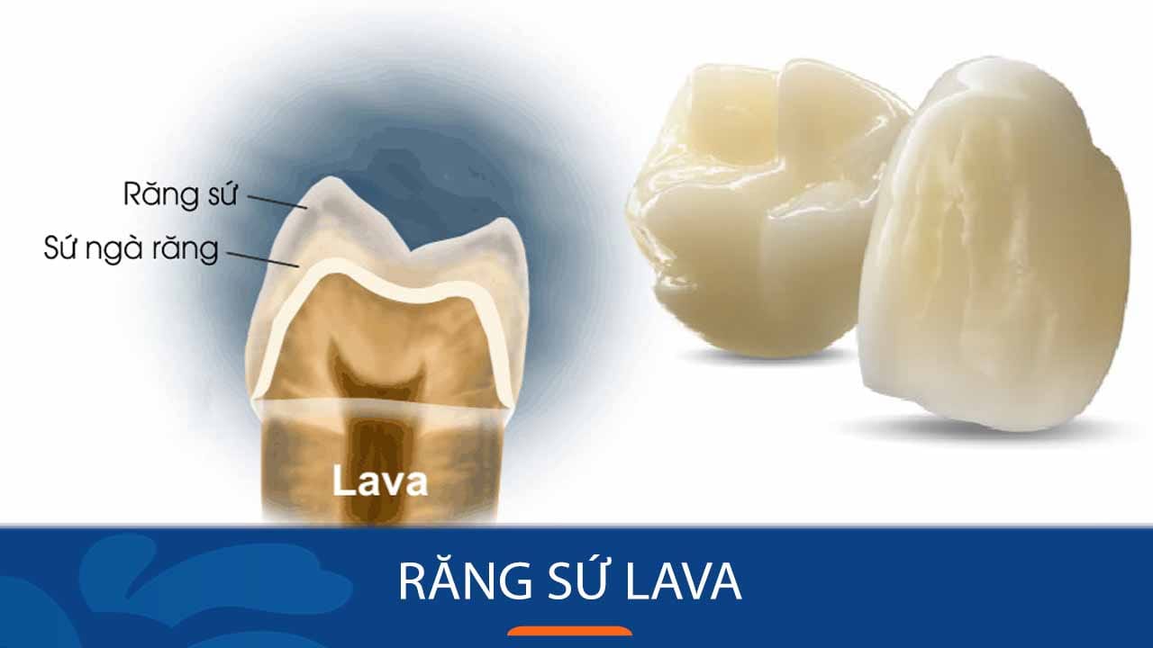 Địa chỉ làm Răng sứ Lava cho Việt Kiều về nước