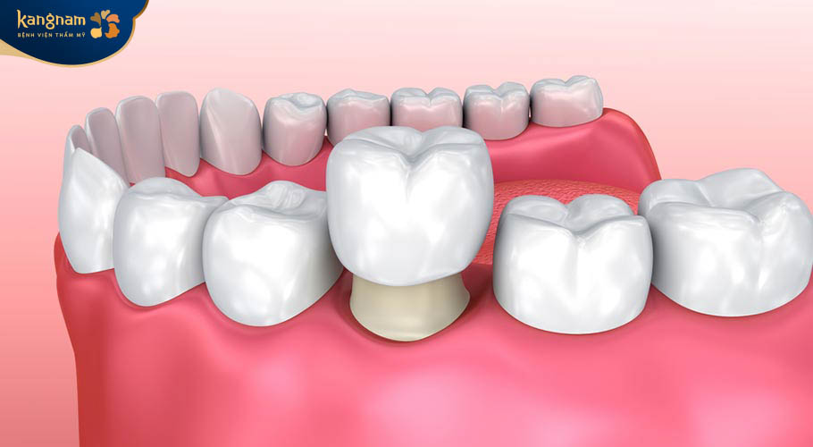 Quy trình bọc răng Titan chuẩn y khoa