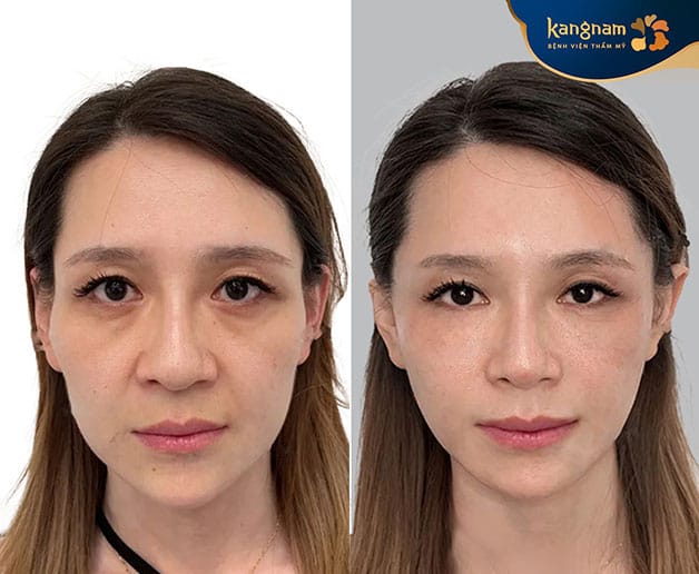 Khách hàng Việt kiều tin tưởng căng chỉ da tại Kangnam