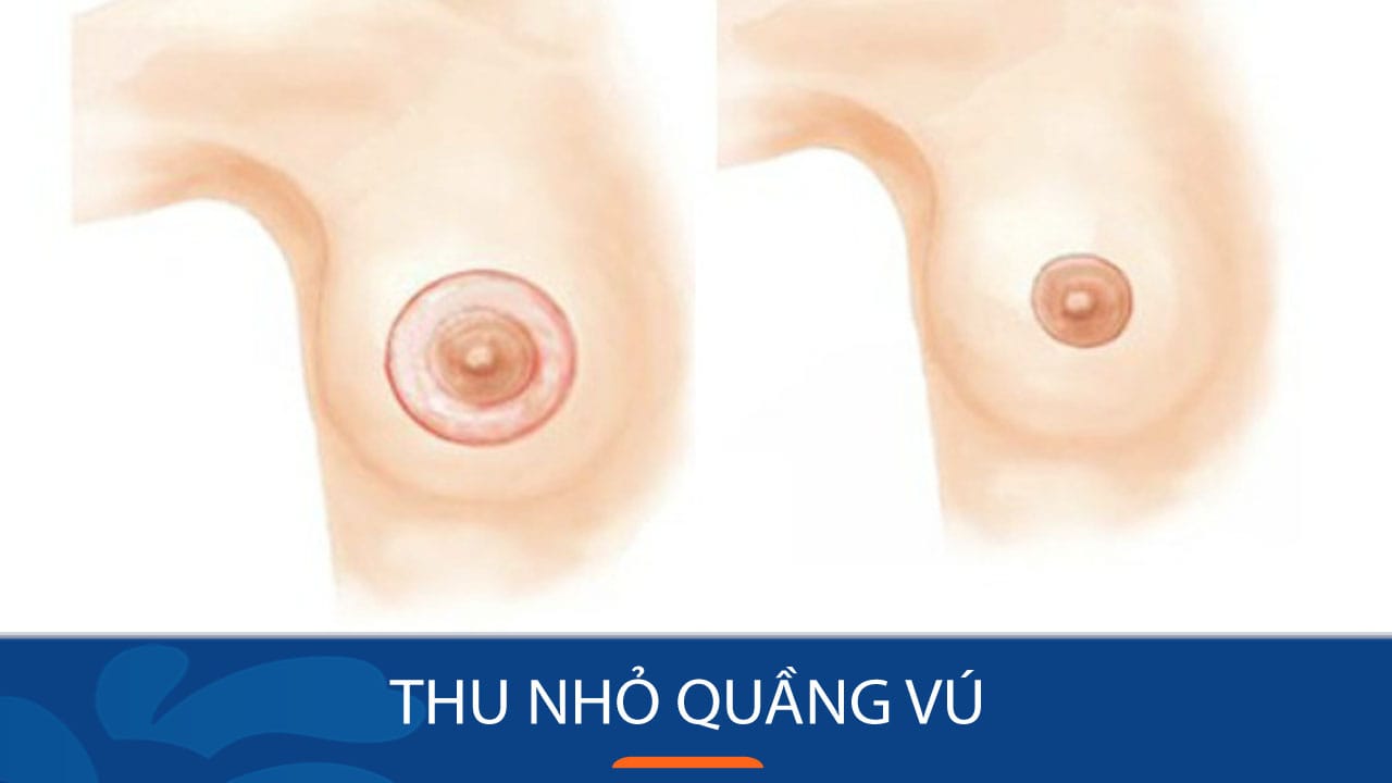 Địa chỉ Thu nhỏ quầng vú dành cho Khách hàng Việt Kiều về nước