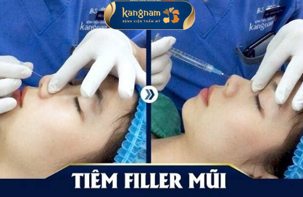 Tiêm filler mũi tại Kangnam an toàn do sử dụng filler chất lượng