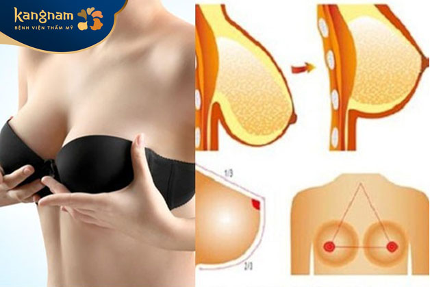 Phương pháp nâng ngực sa trễ chủ yếu dành cho những phụ nữ sau sinh