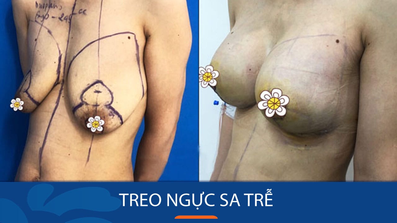 Địa chỉ Treo ngực sa trễ uy tín cho Khách hàng Việt Kiều về nước